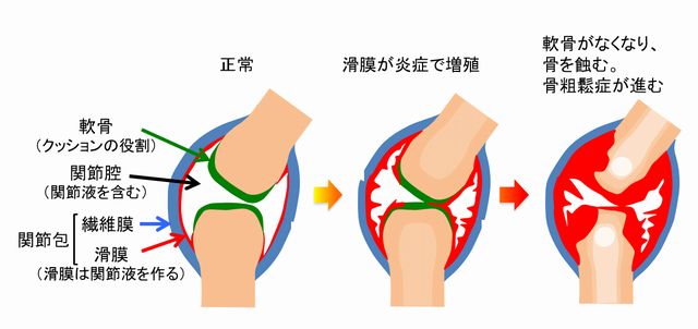 関節リウマチの概念図