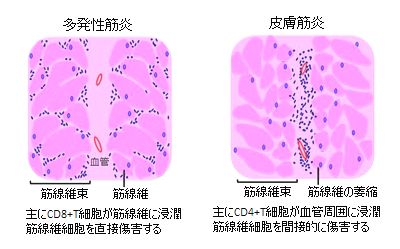 筋炎 皮膚