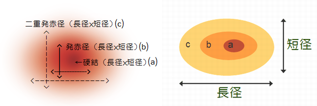 反応 陰性 ツベルクリン